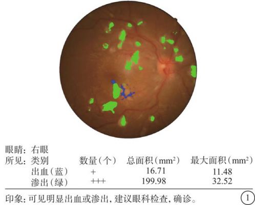 眼底图片分析人工智能（眼底图怎么画）