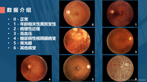 眼底图片分析人工智能(眼底图怎么画)-图2 眼底图片分析人工智能(眼底图怎么画)-图2