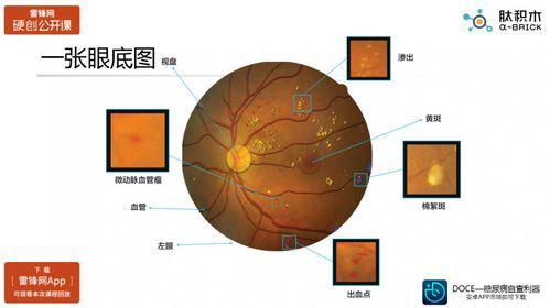 眼底图片分析人工智能(眼底图怎么画)-图3 眼底图片分析人工智能(眼底图怎么画)-图3